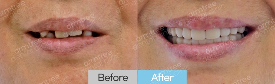 임플란트 심미보철 전후 아름드리치과 진료일기 관련 이미지 10