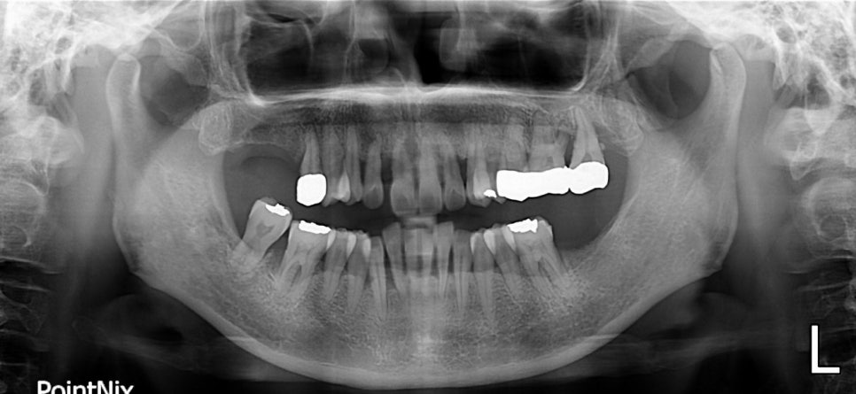당뇨병과 잇몸병?(당뇨합병증 이겨내기) 관련 이미지 5