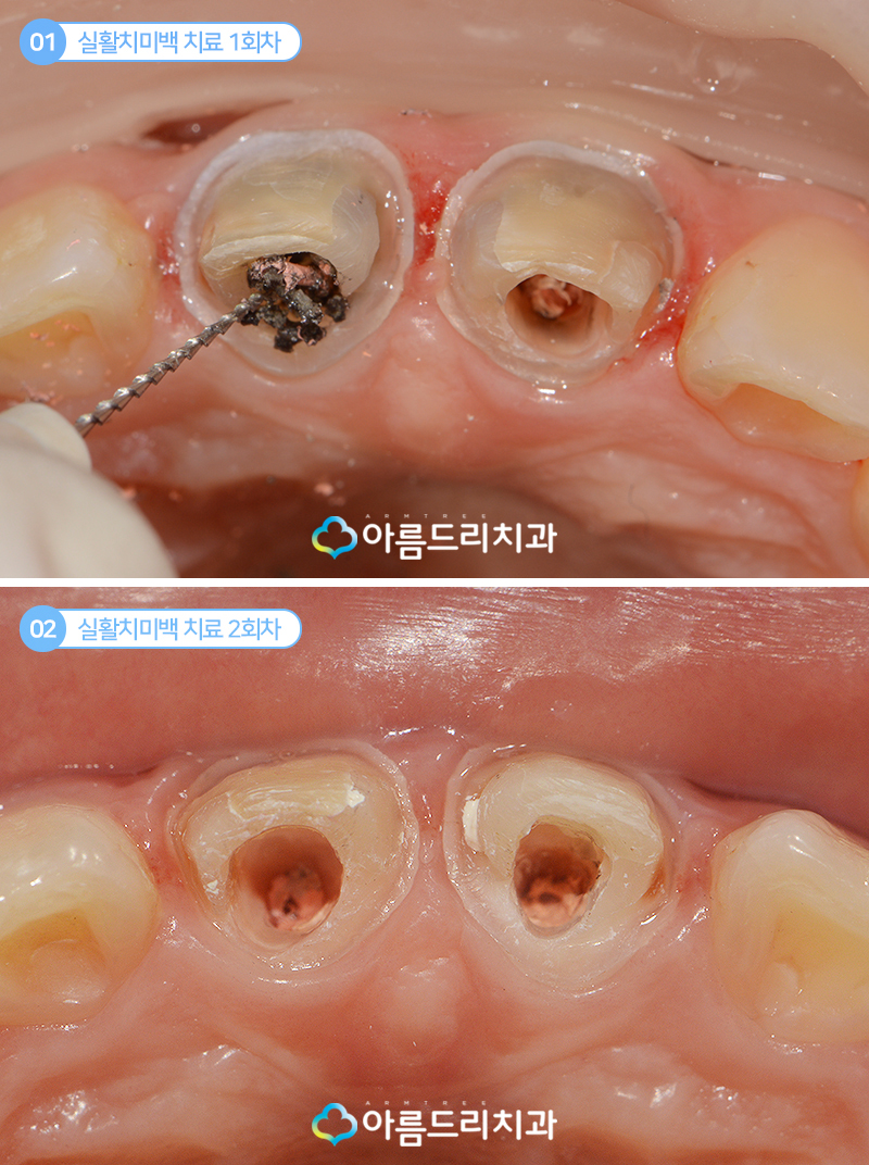 실활치미백 앞니 색깔 신경치료 치아변색 후기 관련 이미지 6