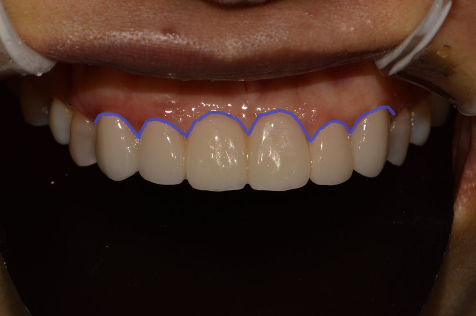 앞니 임플란트_뼈이식_신논현역 치과_아름드리 치과 관련 이미지 3
