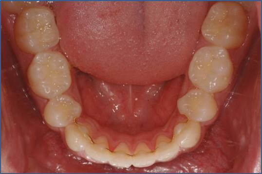 교정 완료_유지 장치 어떤 거 해야 해? 관련 이미지 8