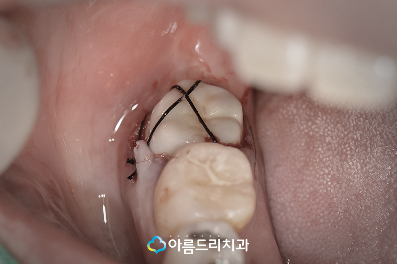 치아재식술 후기 자연치아지키기 관련 이미지 10