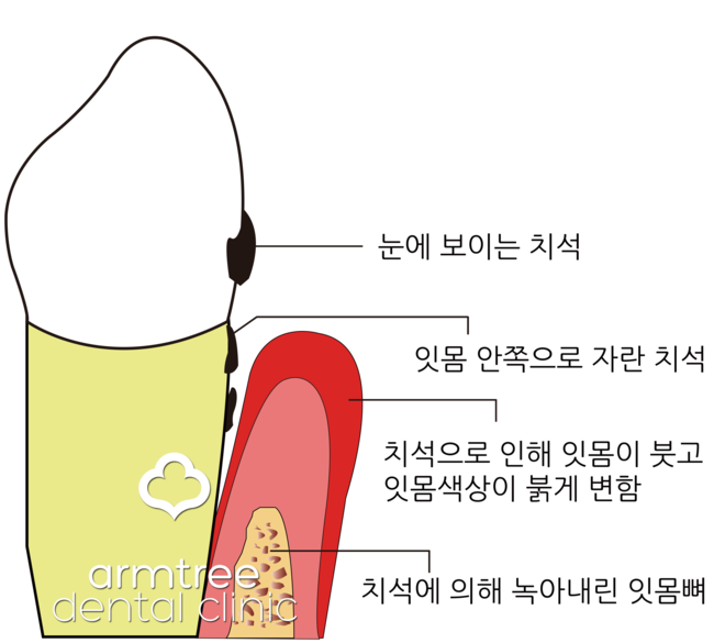 아름드리치과 이현정원장 - 스케일링 왜 중요한가? 관련 이미지 5