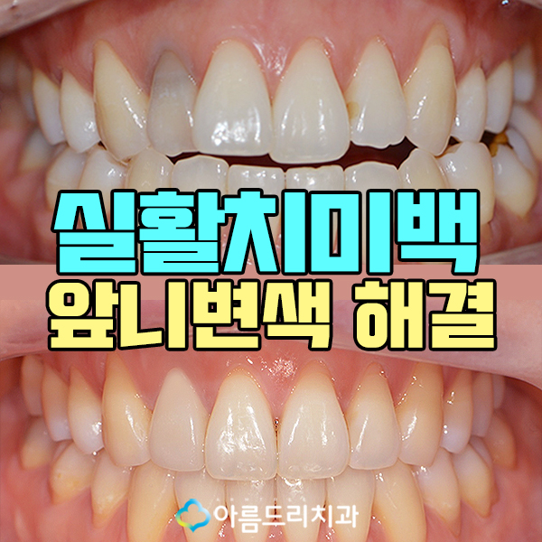 실활치 미백으로 앞니변색 해결후기 관련 이미지 1