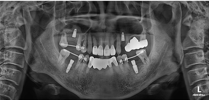 치아를 최대한 보존하는 임플란트 치료 관련 이미지 4