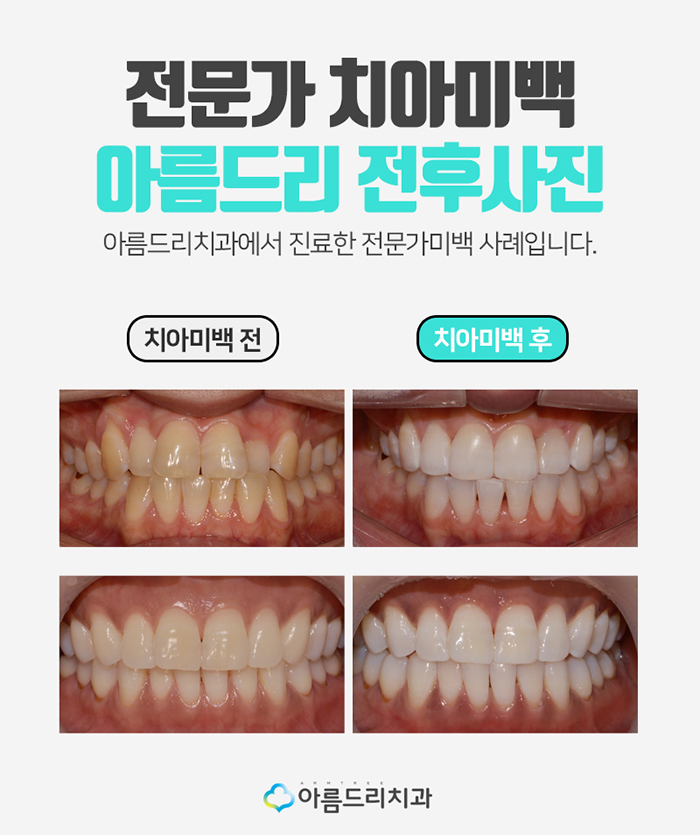 이빨미백 연예인치아미백 누런이 탈출 관련 이미지 8