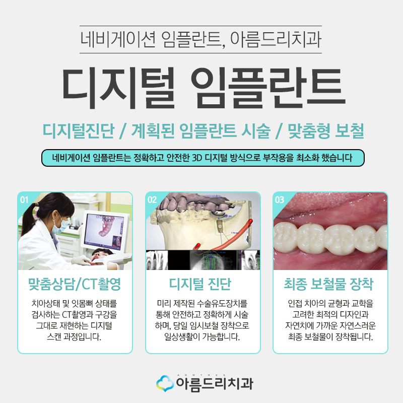 컴퓨터분석임플란트 디지털임플란트 왜? 관련 이미지 3
