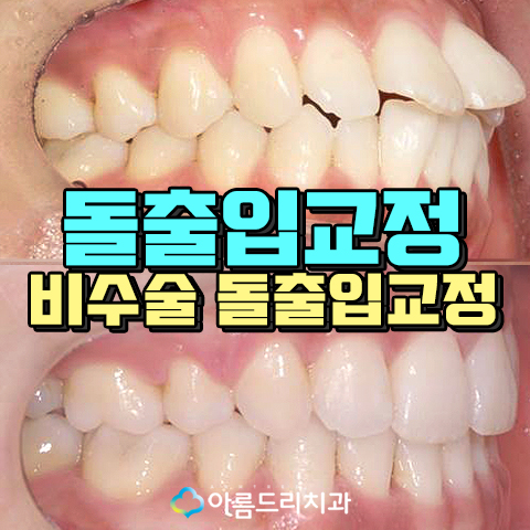 치아교정돌출입 교정후기가 중요햇 관련 이미지 1