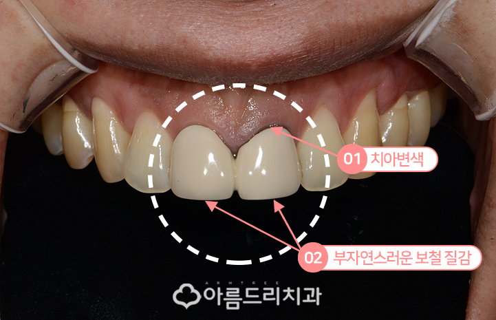 실활치미백 앞니변색까지 해결! 관련 이미지 3