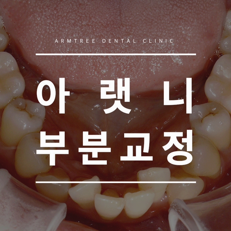 아랫니부분교정 아랫니만 가능한 아름드리치과 관련 이미지 1