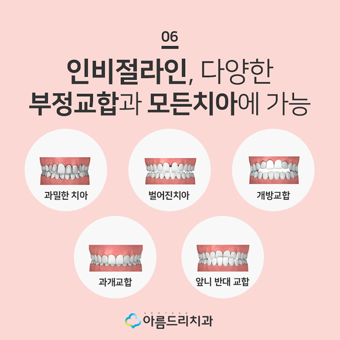 돌출입투명교정 투명교정장치 넘좋다 관련 이미지 8