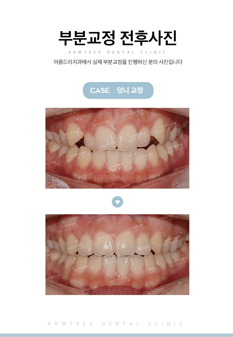 부분교정기간 부담제로 신논현역 아름드리치과 관련 이미지 13