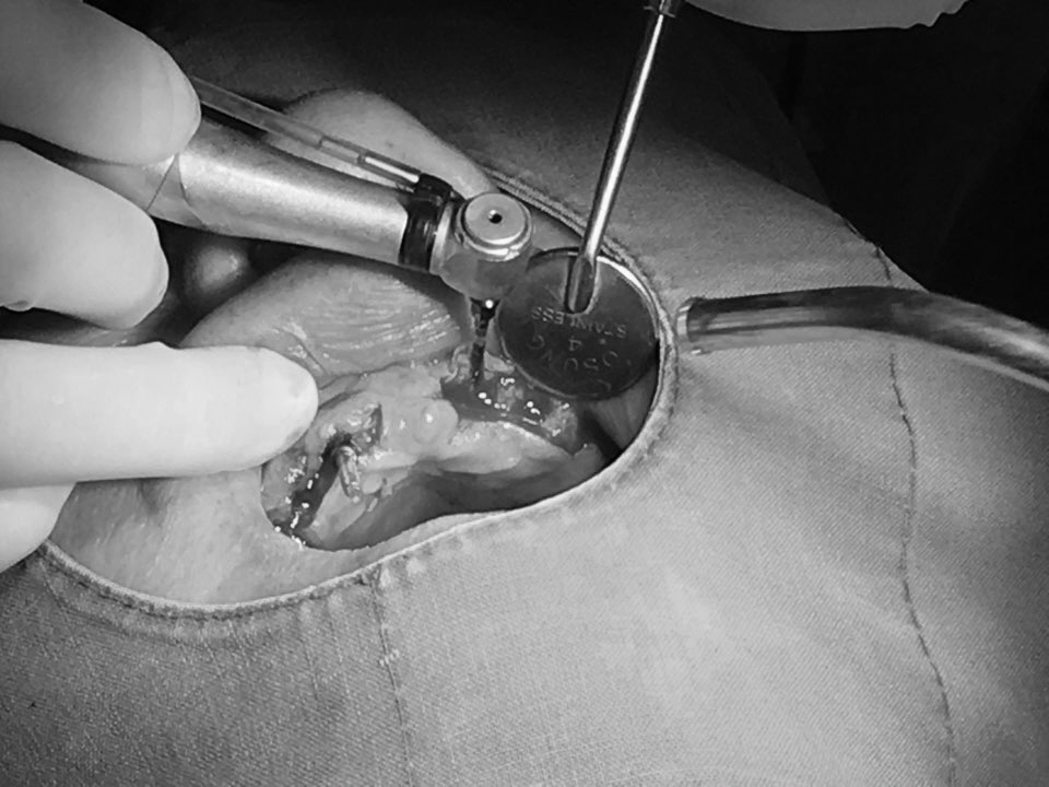 앞니 임플란트_뼈이식_신논현역 치과_아름드리 치과 관련 이미지 12