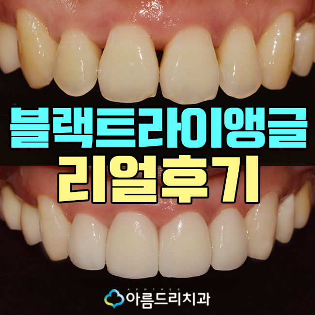 앞니 블랙트라이앵글 치아 이성형으로 해결 관련 이미지 1