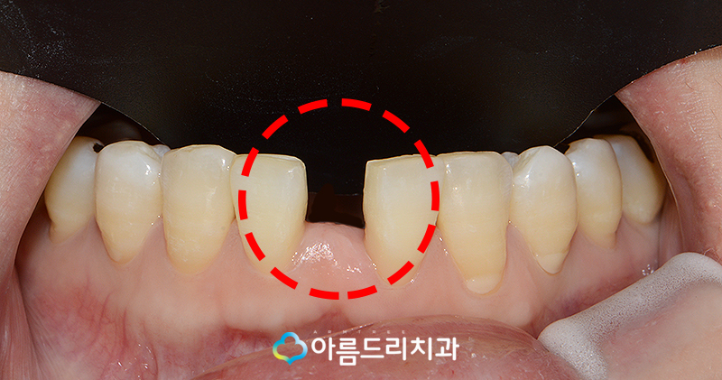 앞니브릿지 치과 치료후기 메릴랜드브릿지 관련 이미지 2