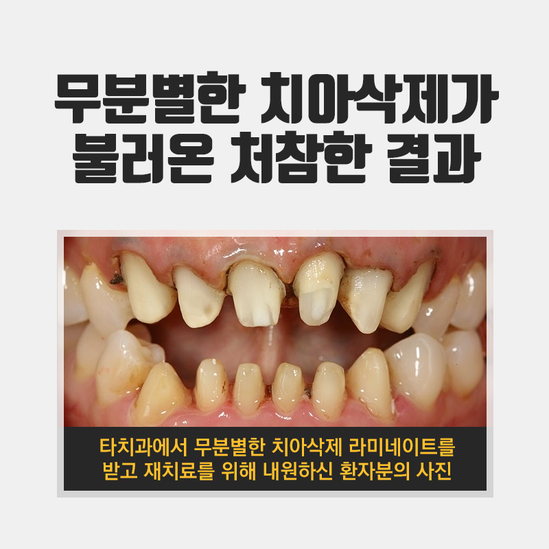 앞니돌출 래미네이트 비용과 가격은? 관련 이미지 2