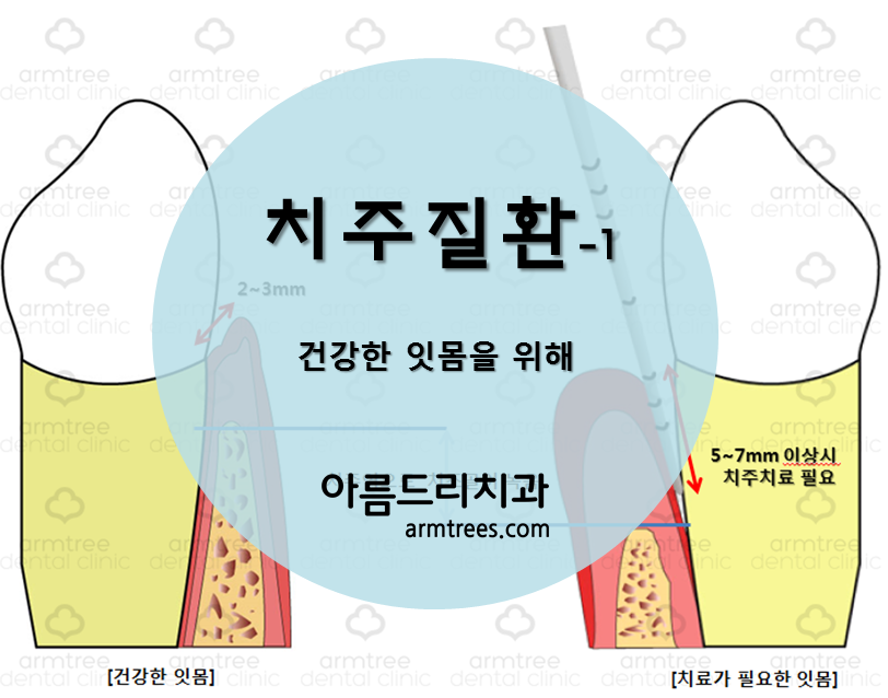 [치주 질환-1] 양치할 때마다 피가 난다?(아름드리 치아상식) 관련 이미지 1