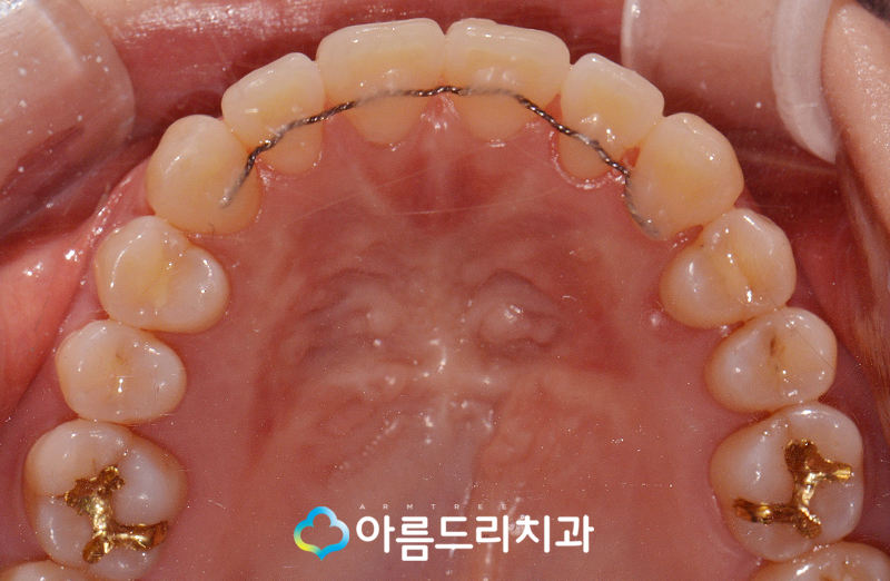 치아부정교합교정 악궁확장장치 후기는? 관련 이미지 11