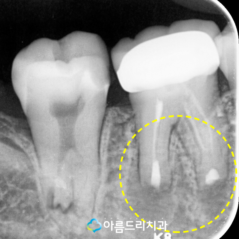 잇몸고름주머니 잇몸에고름 치아재식술 치료 관련 이미지 8