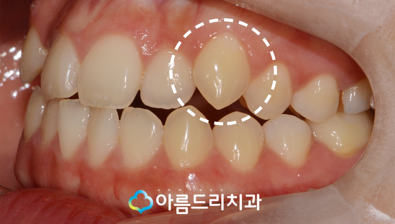 덧니부분교정 앞니 이런후기만 관련 이미지 5