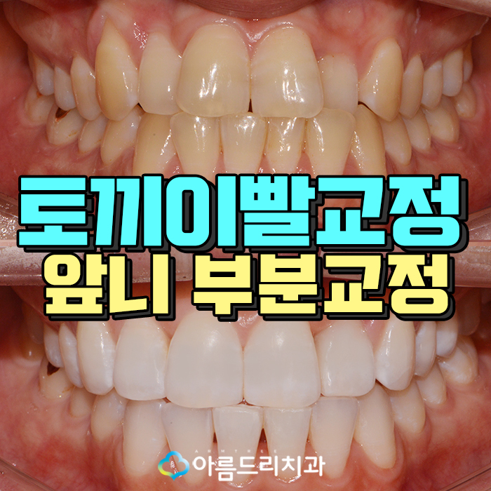토끼이빨교정 앞니문제 해결 관련 이미지 1