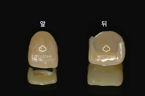 앞니 라미네이트_왜소치아 (최소삭제) 관련 이미지 5