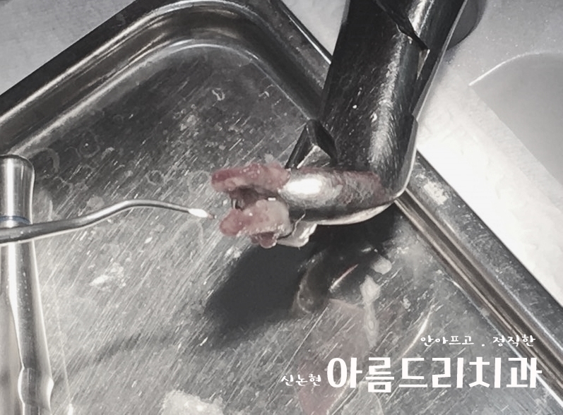 치아재식_임플란트 안 하고 치아 살릴 순 없나요?(신논현역 치과) 관련 이미지 9