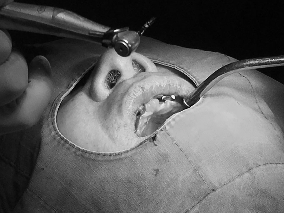 앞니 임플란트_뼈이식_신논현역 치과_아름드리 치과 관련 이미지 14