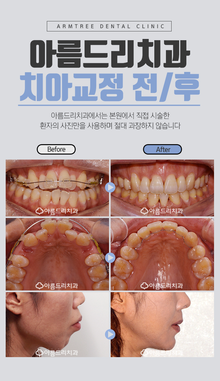 치아교정얼굴변화 어떠한가? 관련 이미지 4