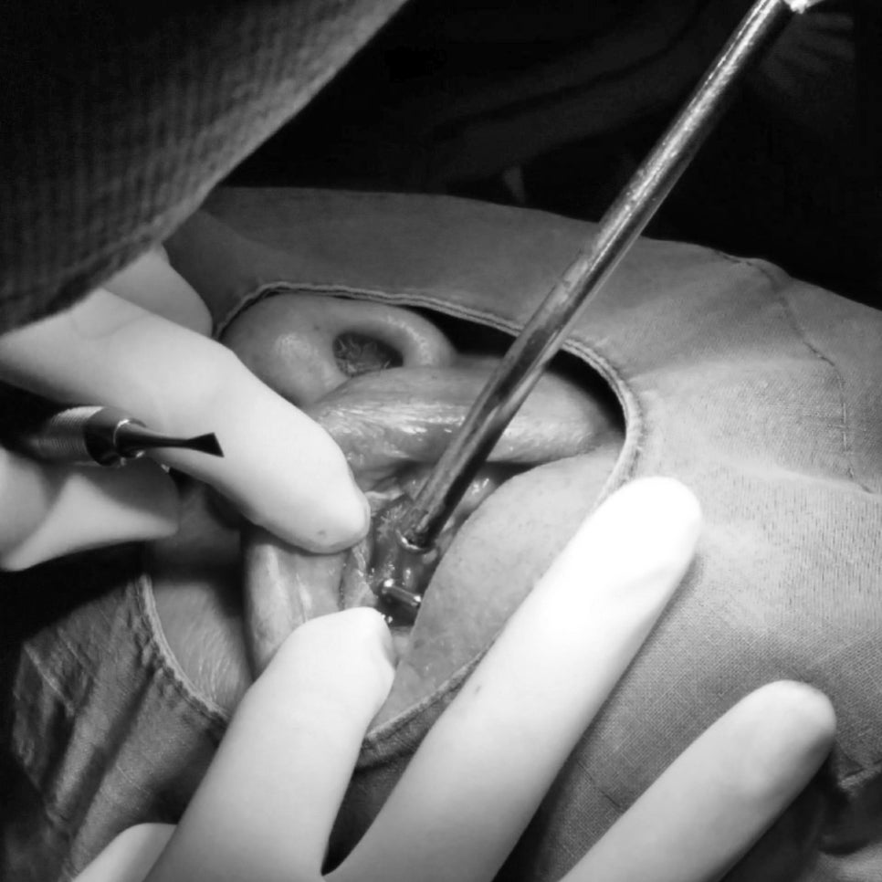 앞니 임플란트_뼈이식_신논현역 치과_아름드리 치과 관련 이미지 8