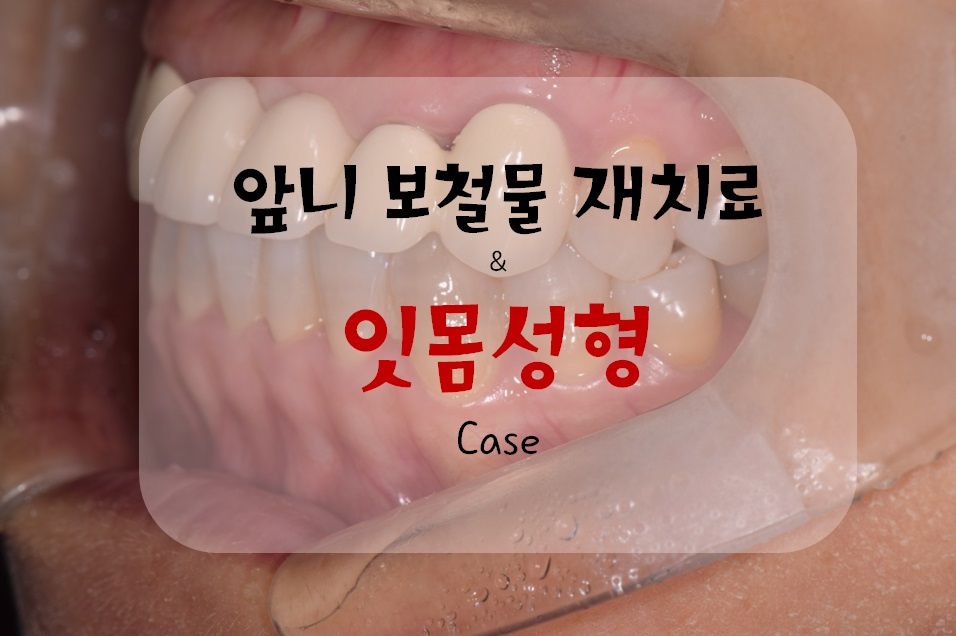 앞니 크라운 재치료 & 잇몸성형 _건강하게 . 예뻐지는 방법 관련 이미지 1