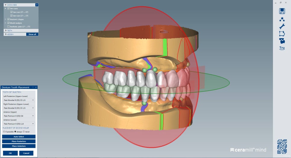 [신논현 치과] 3D 구강 스캐너_정확하게 본뜨기 관련 이미지 5