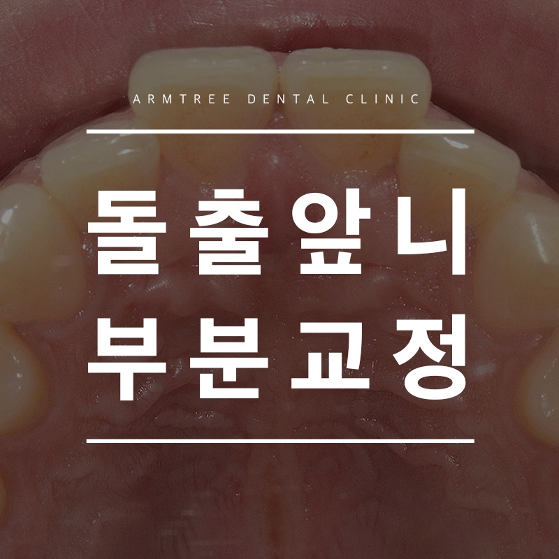 돌출앞니부분교정 신논현역 아름드리치과에서 드라마틱하게 관련 이미지 1
