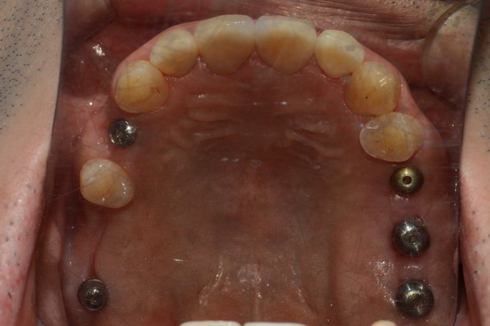 부분교정+임플란트(진료일기) 관련 이미지 5