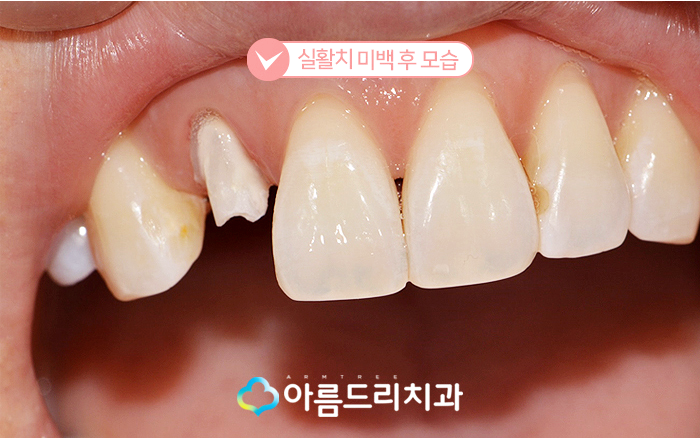 실활치미백 - 앞니변색을 해결하는 치료 관련 이미지 9