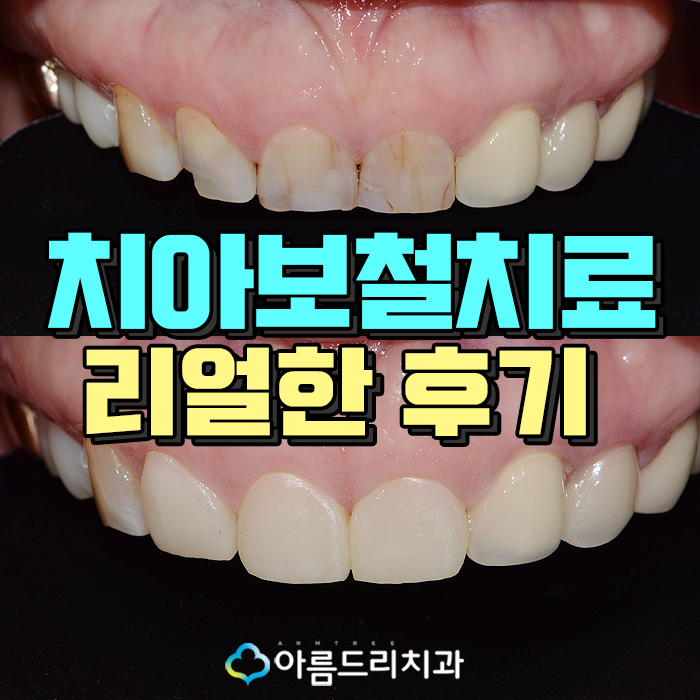 치아보철치료 앞니보철 후기 과연 관련 이미지 1