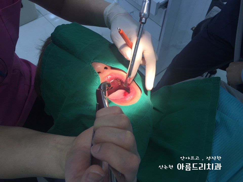 치아재식_임플란트 안 하고 치아 살릴 순 없나요?(신논현역 치과) 관련 이미지 3