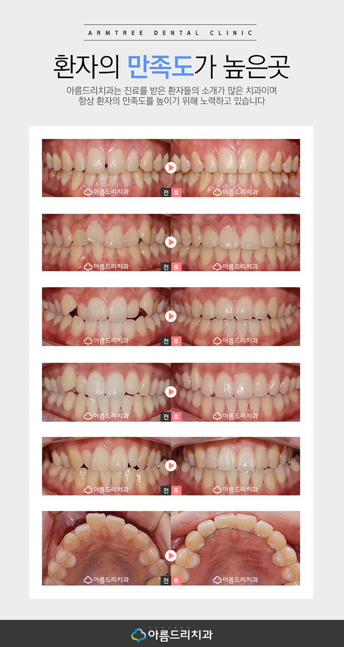 교정결과로 말하는 아름드리치과 관련 이미지 7