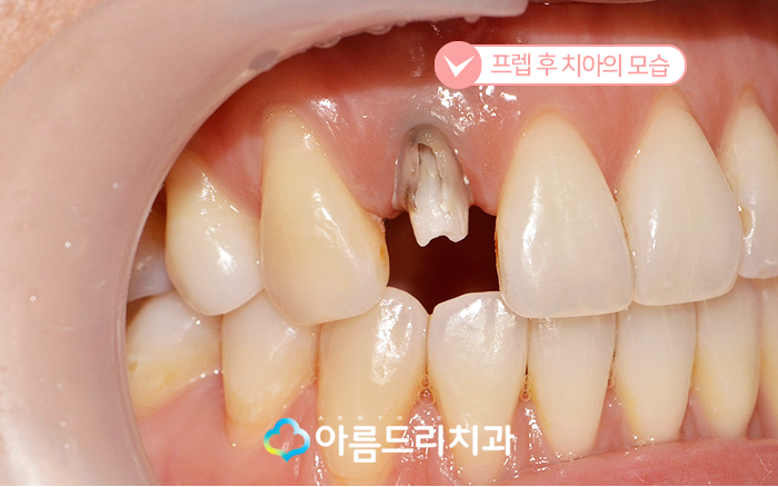 실활치미백 - 앞니변색을 해결하는 치료 관련 이미지 8