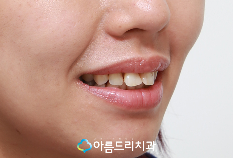 라미네이트연예인 이빨(치아) 최소삭제 이거다 관련 이미지 4