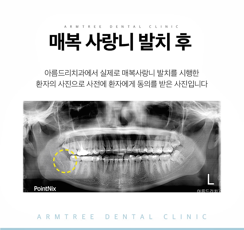 매복사랑니발치 통증없는 아름드리치과 관련 이미지 10