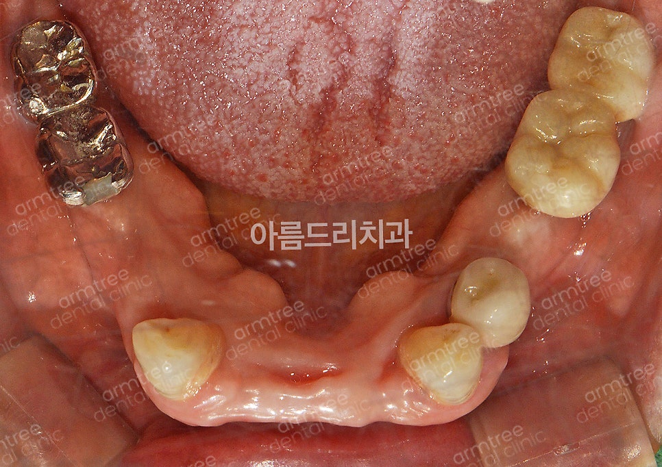 임플란트 심미보철 전후 아름드리치과 진료일기 관련 이미지 4