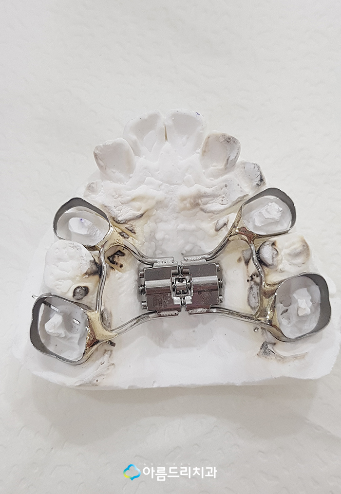 어린이 부정교합교정 RPE 악궁확장장치 관련 이미지 4