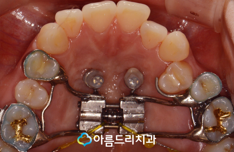 치아부정교합교정 악궁확장장치 후기는? 관련 이미지 8