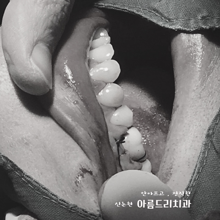 치아재식_임플란트 안 하고 치아 살릴 순 없나요?(신논현역 치과) 관련 이미지 25