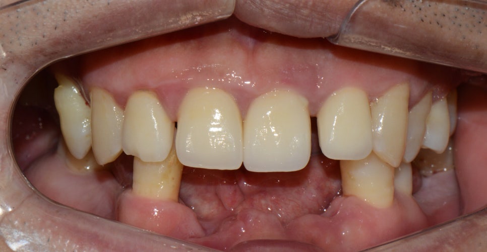 부분교정+임플란트(진료일기) 관련 이미지 2