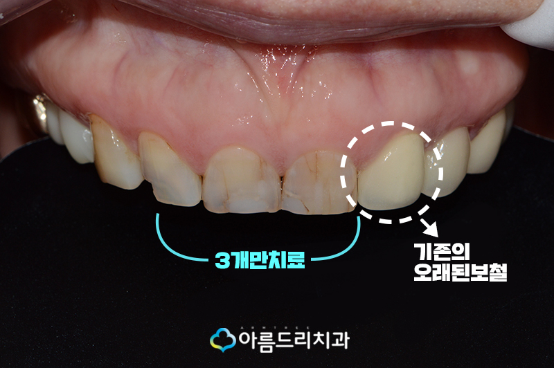 치아보철치료 앞니보철 후기 과연 관련 이미지 4
