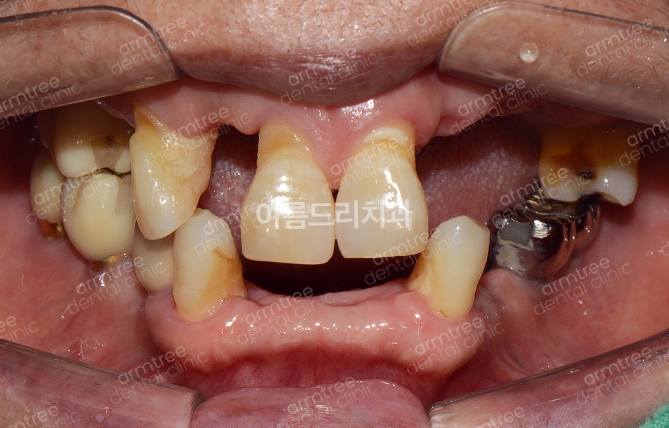임플란트 심미보철 전후 아름드리치과 진료일기 관련 이미지 2