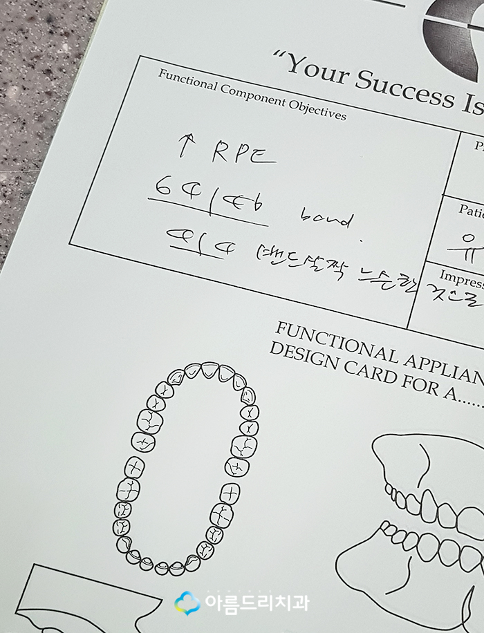 어린이치아교정 부정교합 RPE(급속구개확장장치) 악궁확장장치 관련 이미지 11