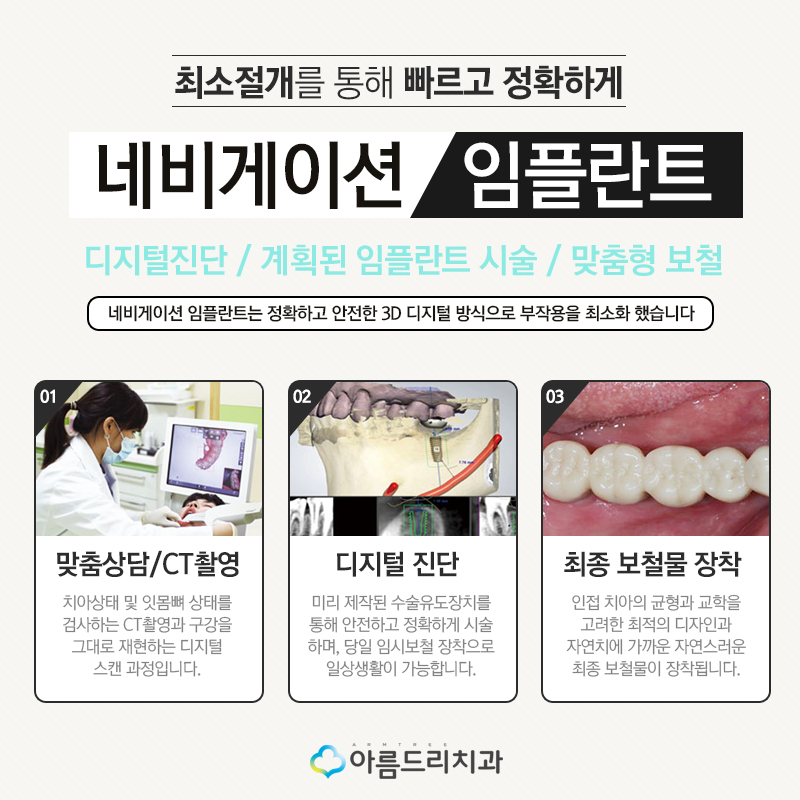 네비게이션 인플란트 기간은 어떻게? 관련 이미지 5